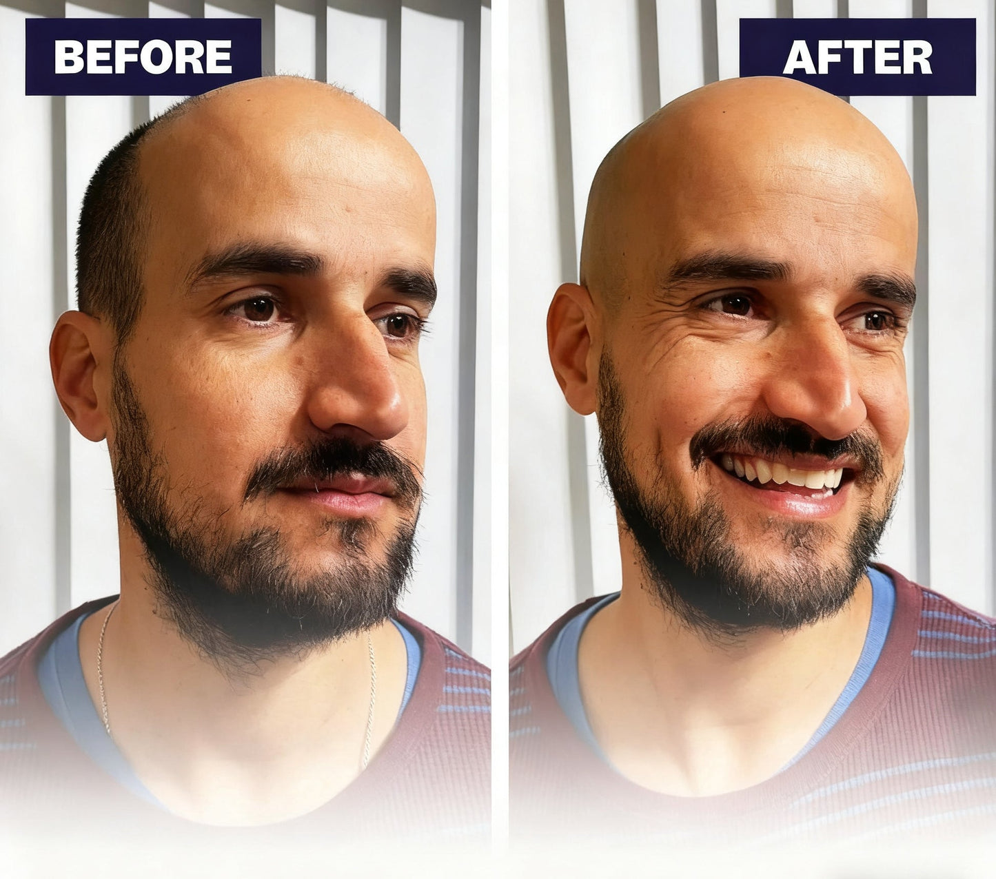 🔥Effortless Head Shaving: Must-Have Shaver For Bald Guys🔥